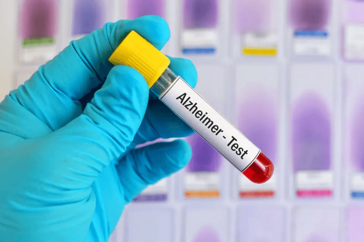 Sekarang Tes Darah Bisa Deteksi Gejala Awal Alzheimer: Studi Menunjukkan Akurasi Tinggi