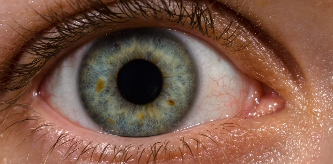 Waspada Mata Kering di Usia Muda! Bisa Jadi Tanda Autoimun Serius seperti Sjogren Syndrome