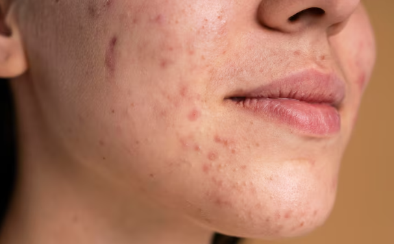 Cara Menghilangkan Jerawat di Hidung, Ini Tips Ampuh Biar Wajah Mulus Tanpa Bekas