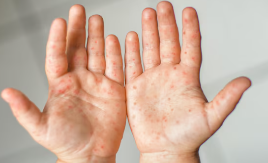 Cara Menangani Virus Campak Pada Anak Di Rumah, Lakukan 7 Langkah Penting Ini Agar Buah Hati Cepat Pulih Dan Bebas Komplikasi!
