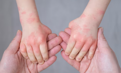 Gejala Campak Pada Anak Yang Sering Diabaikan, Waspada Penularan Virus Paramyxovirus Dan Pentingnya Vaksinasi Sejak Dini