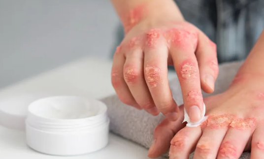 Obat Alami Herpes Paling Ampuh Buat Redakan Perih, Cara Mudah Atasi Gejala Luka Lepuh Di Kulit Pakai Bahan Rumahan Tanpa Ribet