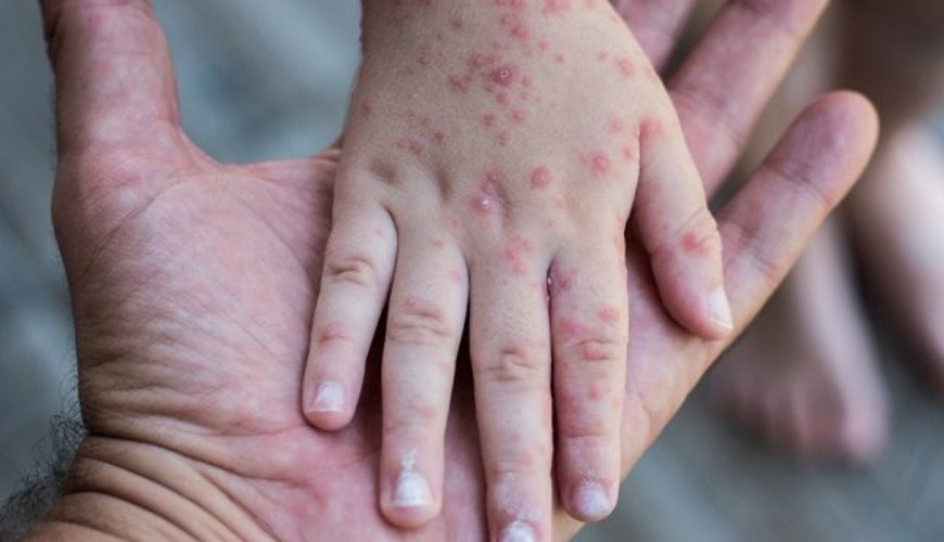 PAPDI Tegaskan Campak Bukan COVID-19 atau Rubella, Ini Perbedaannya