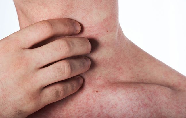 Waspada! Berikut Penyebab HIV yang Tidak Diketahui Banyak Orang