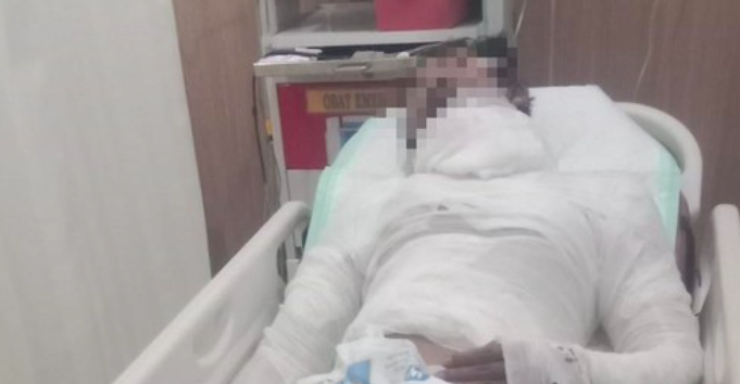Sopir Truk Karangasem yang Dibakar Bosnya Meninggal Dunia, Sempat Alami Luka Bakar 68 Persen