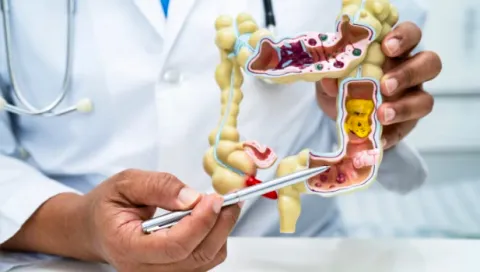 Sering Dianggap Sepele, 10 Gejala Kanker Usus Besar Ini Bisa Muncul Tanpa Disadari
