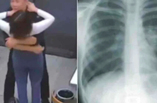 Waspada Osteoporosis di Usia Muda! Wanita Ini Alami 5 Tulang Rusuk Patah Gegara Pelukan