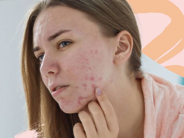 Punya Kulit Berjerawat, Hindari 7 Kandungan Skincare Ini