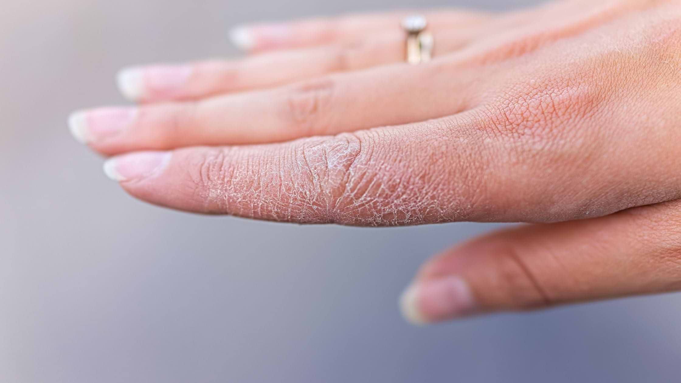 Tangan Kering dan Kusam, Begini Rutinitas Skincare Pagi-Malam untuk Mengatasinya