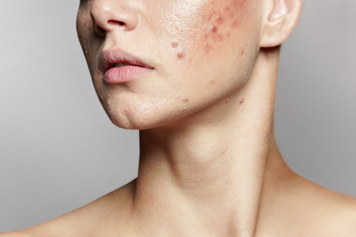 Wajah Glowing Saat PMS? Bisa Banget! Ini Cara Biar Jerawat Gak Ikut Muncul